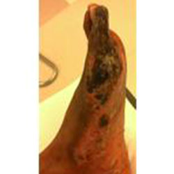 woundcare