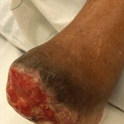 woundcare