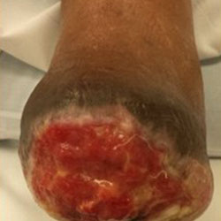 woundcare