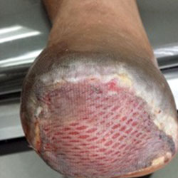 woundcare