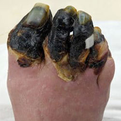 woundcare