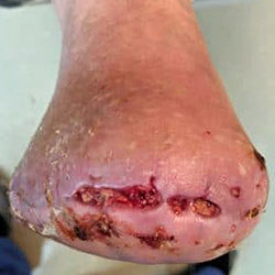 woundcare