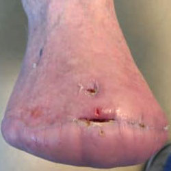 woundcare