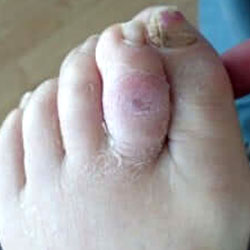 woundcare